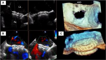 Successful Evolution of Atrial Septal Defect Closure in an Elderly Patient With Complex Cardiovascular Disease