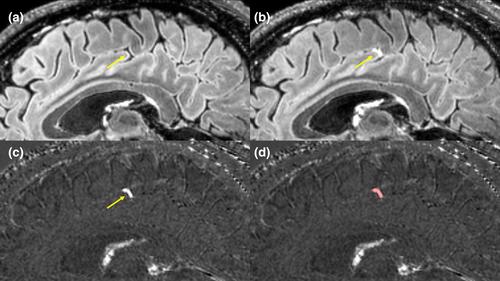 Pooled analysis of multiple sclerosis findings on multisite 7 Tesla MRI: Protocol and initial observations