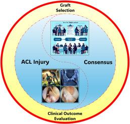 Diagnosis and treatment of anterior cruciate ligament injuries: Consensus of Chinese experts part II: Graft selection and clinical outcome evaluation