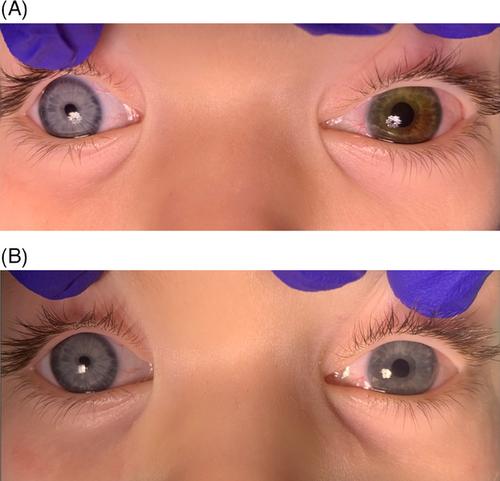 Child presenting with unilateral vision loss