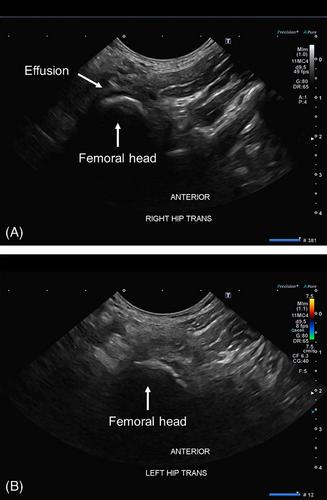 A toddler with transient synovitis and COVID-19 infection