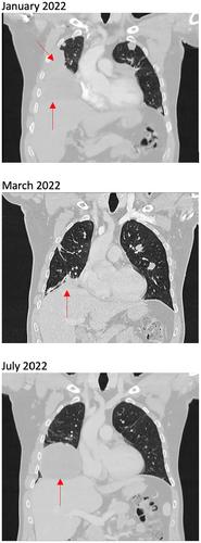 Metastatic Non-Myofibroblastic Sarcoma Harbouring EML4-ALK Fusion—Dramatic Response to ALK Tyrosine Kinase Inhibitors and Development of Resistance Mutations