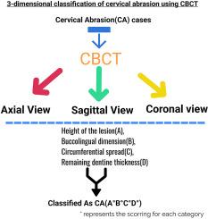 Novel 3-dimensional classification of cervical abrasion using CBCT: A comprehensive analysis