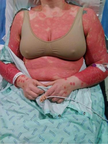 An unusual acute erythrodermic rash