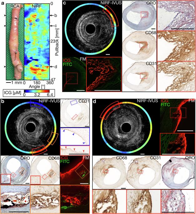 Intravascular ICG-enhanced NIRF-IVUS imaging to assess progressive atherosclerotic lesions in excised human coronary arteries