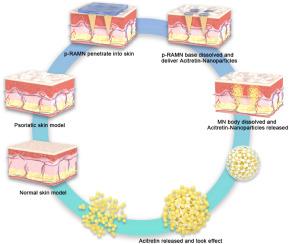 A transdermal delivery system using microneedle patches containing poly(lactic-co-glycolic)-encapsulated acitretin nanoparticles for topical and extended treatment