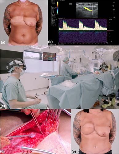 Fully Telemetric Robotic Microsurgery: Clinical Experience With 23 Cases