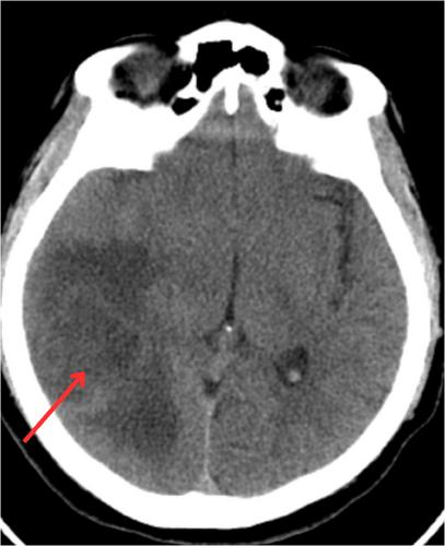 Image: Clubbing and hypoxia