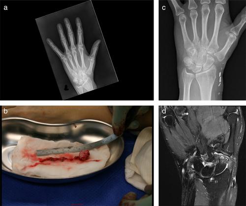 Interposition of Free Vascularized Fascia Into the Trapezial Resection Cavity for the Surgical Treatment of Trapeziometacarpal Osteoarthritis