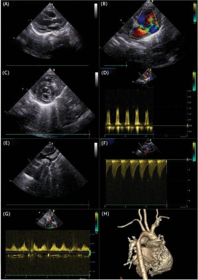 Double-orifice mitral valve associated with mild mitral stenosis and coarctation of the aortic isthmus: A rare case of incomplete form of Shone's syndrome