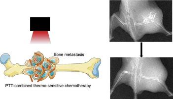 A simple nanoplatform of thermo-sensitive liposomes and gold nanorods to treat bone metastasis through improved chemotherapy combined with photothermal therapy