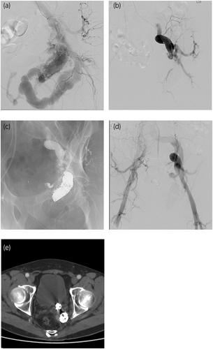 A giant pelvic arteriovenous malformation