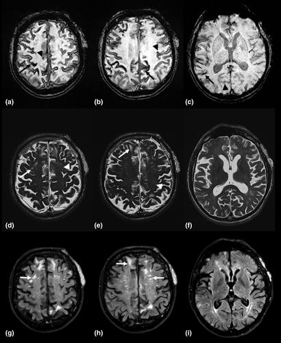 Clinical and neuroimaging precursors in cerebral amyloid angiopathy: impact of the Boston criteria version 2.0