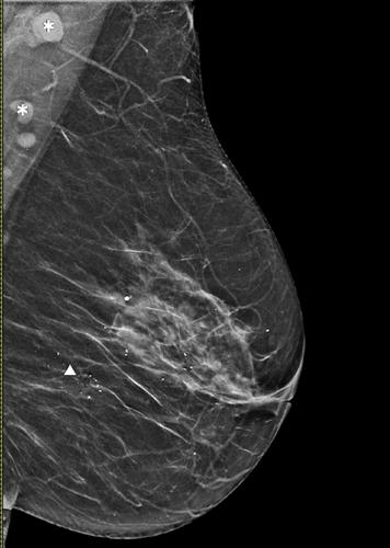 Localized AL amyloidosis of the breast in a geriatric female