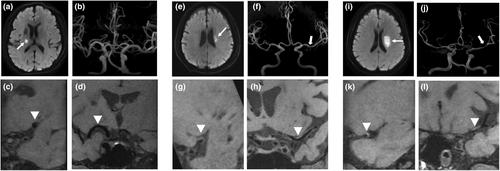 Small vessel disease burden and prognosis of recent subcortical ischaemic stroke differ by parent artery atherosclerosis