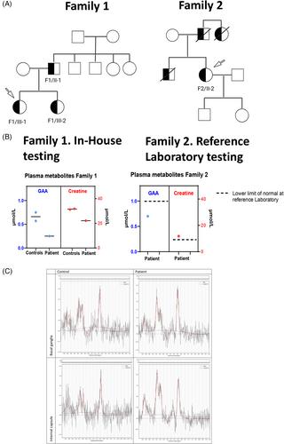 Reduced guanidinoacetate in plasma of patients with autosomal dominant Fanconi syndrome due to heterozygous P341L GATM variant and study of organoids towards treatment