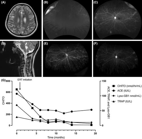 Gaucher disease type 3c: Expanding the clinical spectrum of an ultra-rare disease