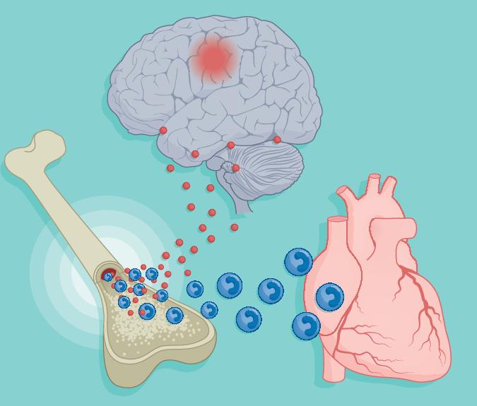 Stroke triggers an innate immune memory that drives cardiac dysfunction