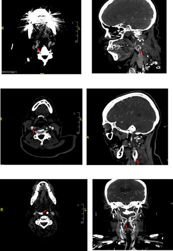 In-hospital recurrent stroke in ipsilateral carotid web patients undergoing thrombectomy