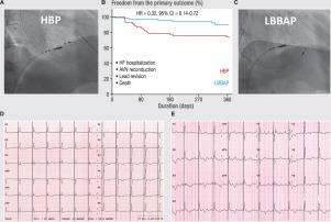 His bundle pacing versus left bundle branch area pacing in patients undergoing atrioventricular node ablation: A prospective and comparative study