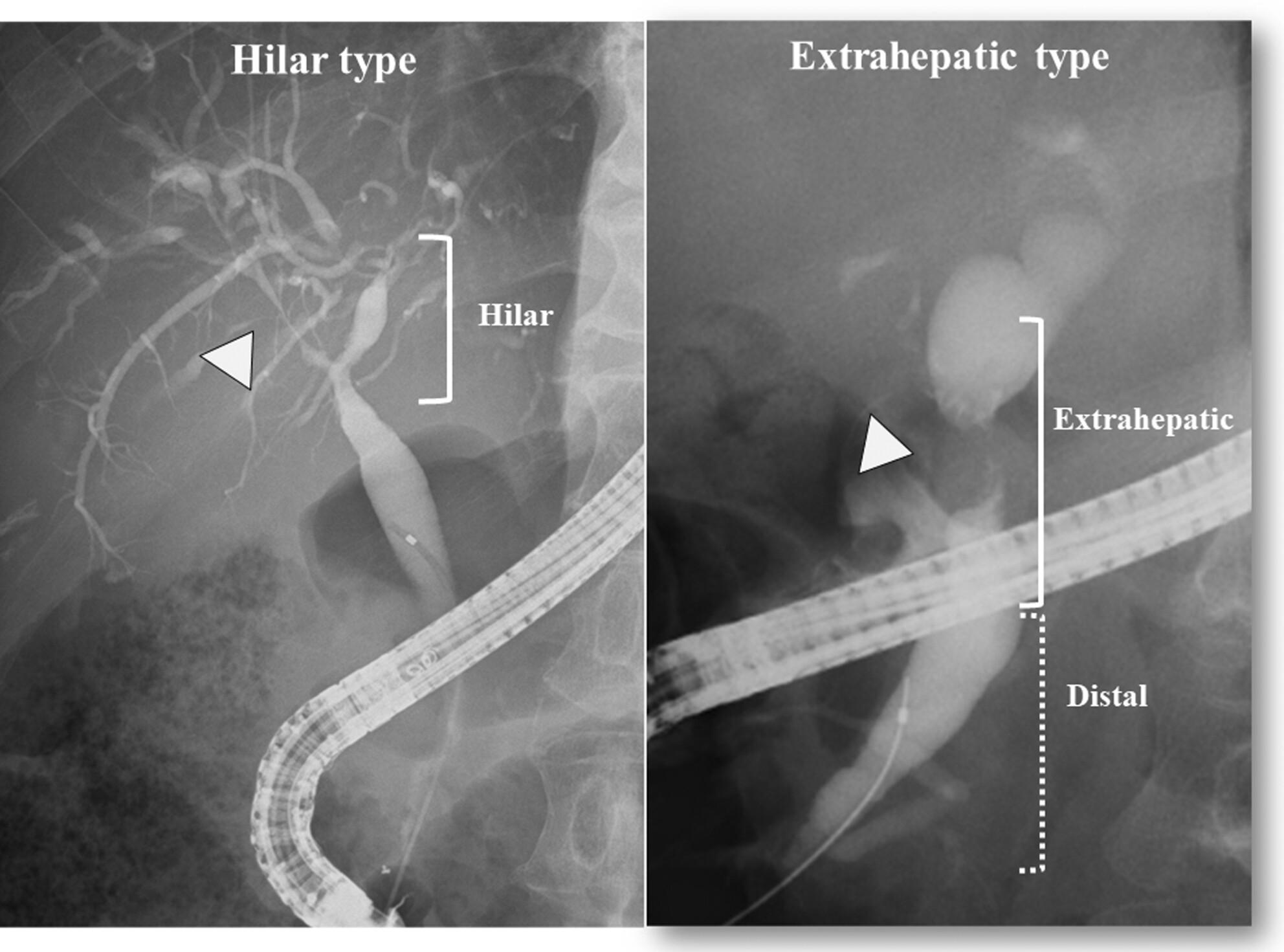 Diagnosis of isolated hilar-/extrahepatic-type IgG-4-related sclerosing cholangitis can be increased by improved recognition of this condition—A Japanese multicenter analysis