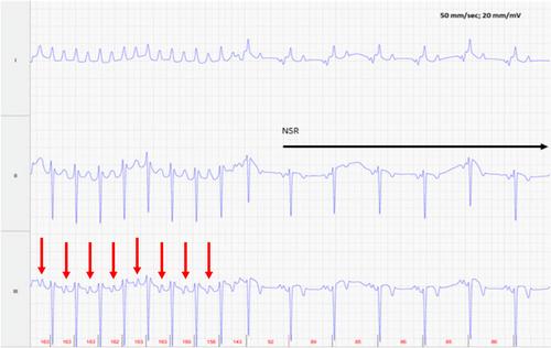 Intravenous administration of quinidine and metoprolol for treatment of atrial fibrillation in 2 neonatal foals