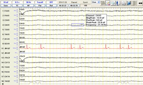 Use of sedation-awakening electroencephalography in dogs with epilepsy