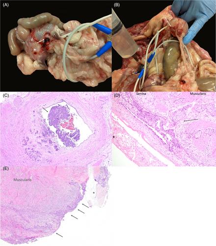 Urothelial carcinoma associated with a long-term indwelling cystostomy component of a subcutaneous ureteral bypass device in a domestic shorthair cat