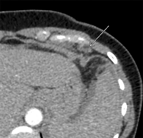 Spontaneous atraumatic epipericardial fat necrosis in the context of recent oocyte retrieval and ovarian hyperstimulation syndrome