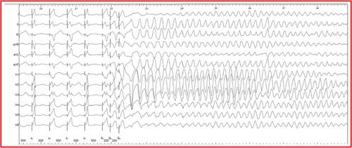 Induction of ventricular fibrillation during programmed ventricular stimulation in a patient with CASQ2 heterozygous mutation