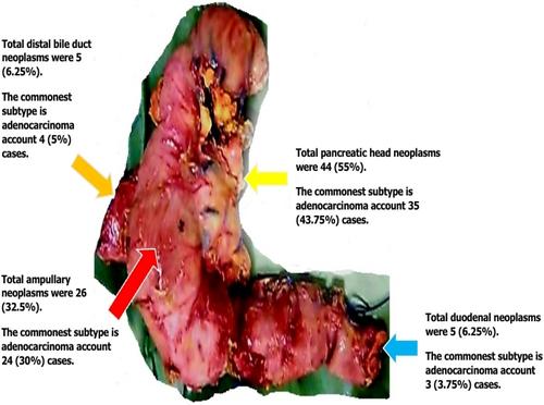 Surgical management and histopathological patterns of periampullary cancers in Sudanese patients: A single-center prospective study