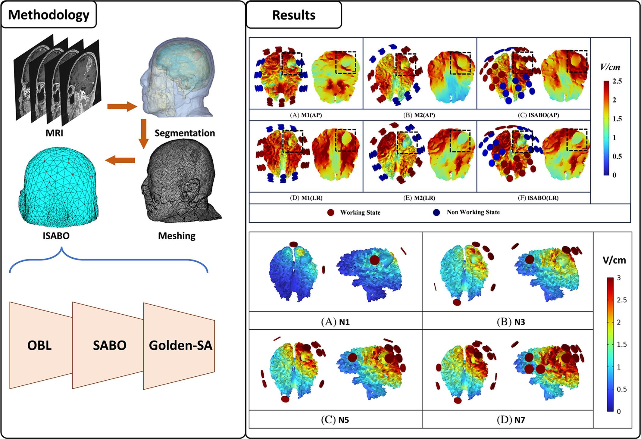 Personalized optimization strategy for electrode array layout in TTFields of glioblastoma