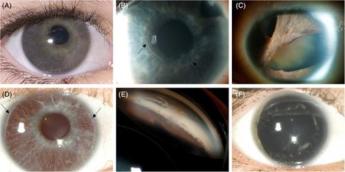 Childhood glaucoma: Implications for genetic counselling