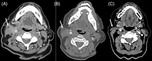 Sequelae of carotid endarterectomy patch infection: An otolaryngologist perspective