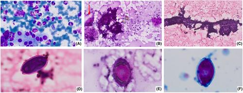 The diagnostic conundrum of hyper eosinophilia—Sheer tenacity of a parasite