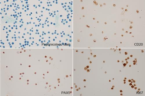 A case report of primary central nervous system lymphoma with immune deficiency/disorder setting diagnosed by cerebrospinal fluid cytology