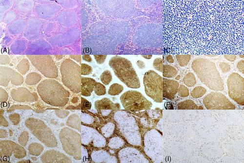 Low-grade follicular lymphoma with interferon regulatory factor-4 rearrangement: Expanding the spectrum of interferon regulatory factor-4-rearranged lymphomas