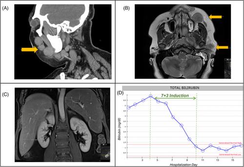 Acute myeloid leukemia presenting with hepatic dysfunction: Should induction be dose reduced?