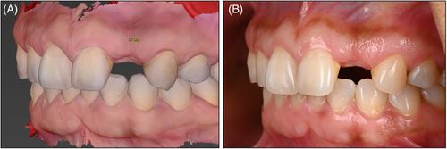 The Bio-Restorative Concept for Implant-Supported Restorations