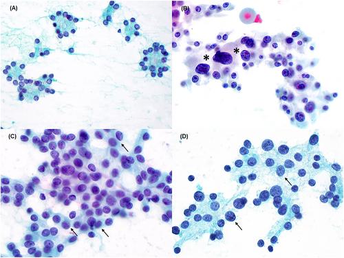 Follicular neoplasms with nuclear atypia versus other types of atypia: Should follicular neoplasms be stratified according to the presence of nuclear atypia?