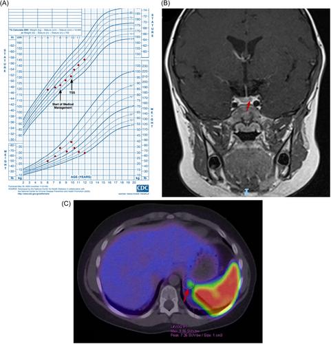 Diagnostic and management challenges in paediatric Cushing's syndrome