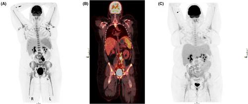 Idiopathic multicentric Castleman disease with marrow fibrosis and extramedullary hematopoiesis