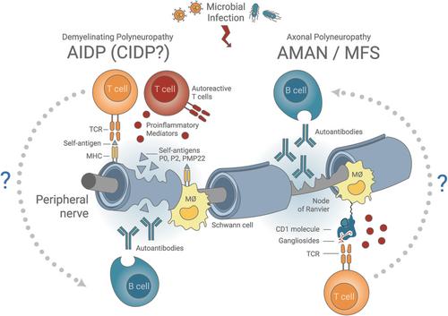 Expanding our understanding of Guillain–Barré syndrome: Recent advances and clinical implications