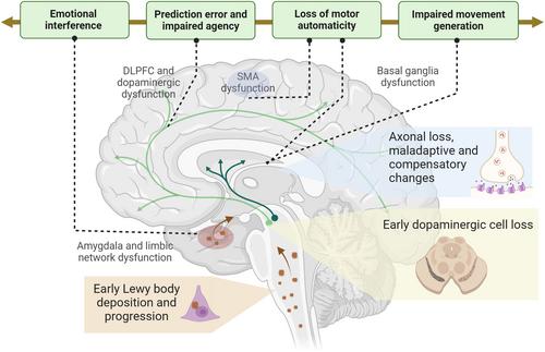 Functional Movement Disorder as a Prodromal Symptom of Parkinson's Disease—Clinical and Pathophysiological Insights