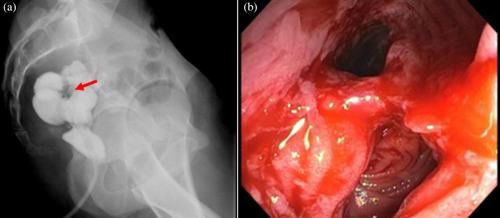 Management of ileoanal J-pouch bridge by transanal endoscopic assisted stapled septotomy