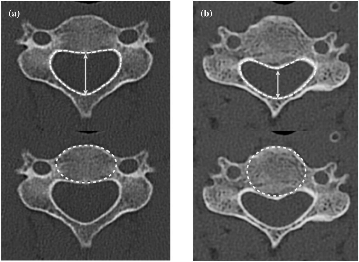 Anteroposterior cervical spine canal diameter: exploring ethnic variation between European and Polynesian populations