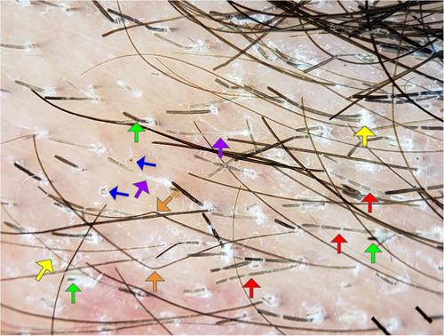 Trichoscopy of tinea capitis caused by Microsporum audouinii