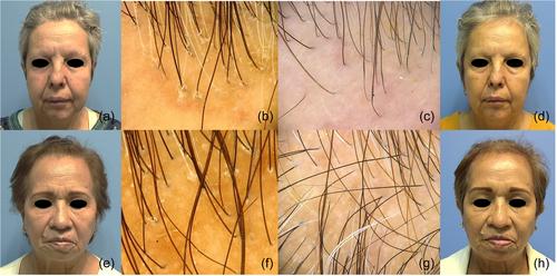 A clinical trial on the efficacy of mesotherapy with dutasteride for frontal fibrosing alopecia