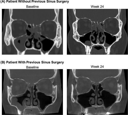 EDS-FLU efficacy in patients with chronic rhinosinusitis with or without prior sinus surgery in ReOpen1 and ReOpen2 randomized controlled trials