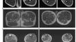 Novel mutation of SMPX-related scapuloperoneal myopathy and myofibrillar myopathy.